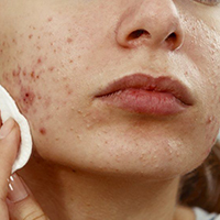 Can high street acne treatments really get rid of your spots?